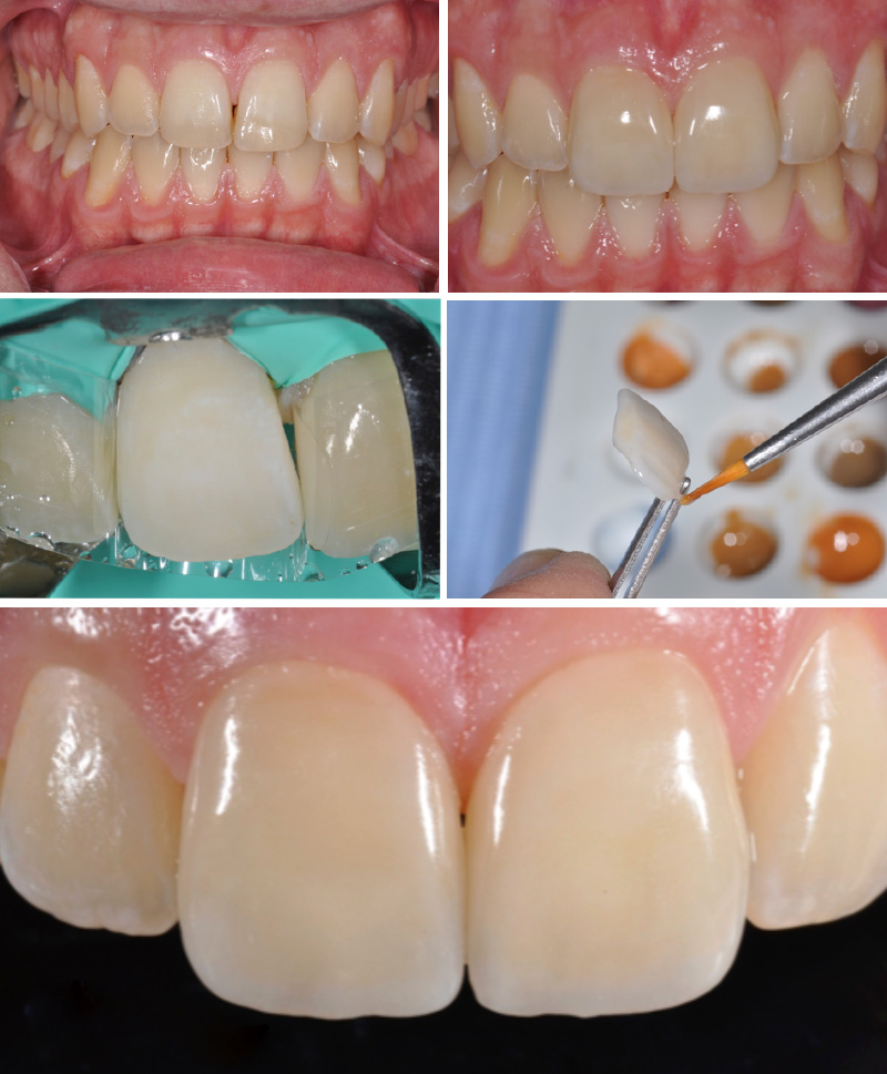 traumi-dentali-04-studio-dentistico-michele-damelio-venezia-mestre