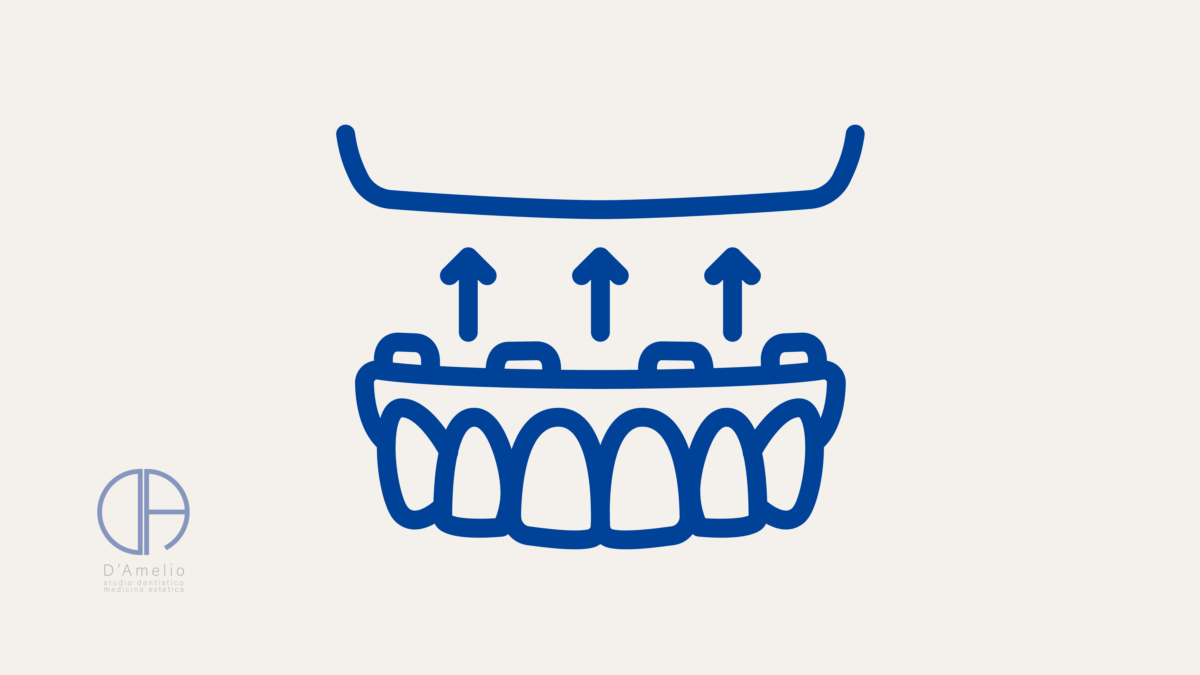 All-on-4 o All-on-6: di cosa si tratta?