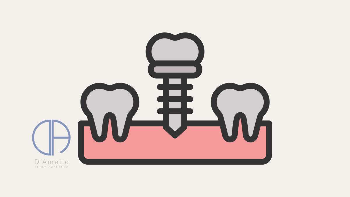 Impianti Dentali